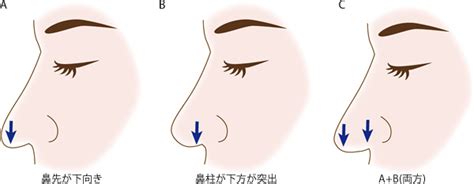 鼻頭中間凹|鼻の名称・形・種類とその治療法について（だんご鼻。